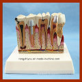 Dental Care Pathological Tooth Anatomical Model